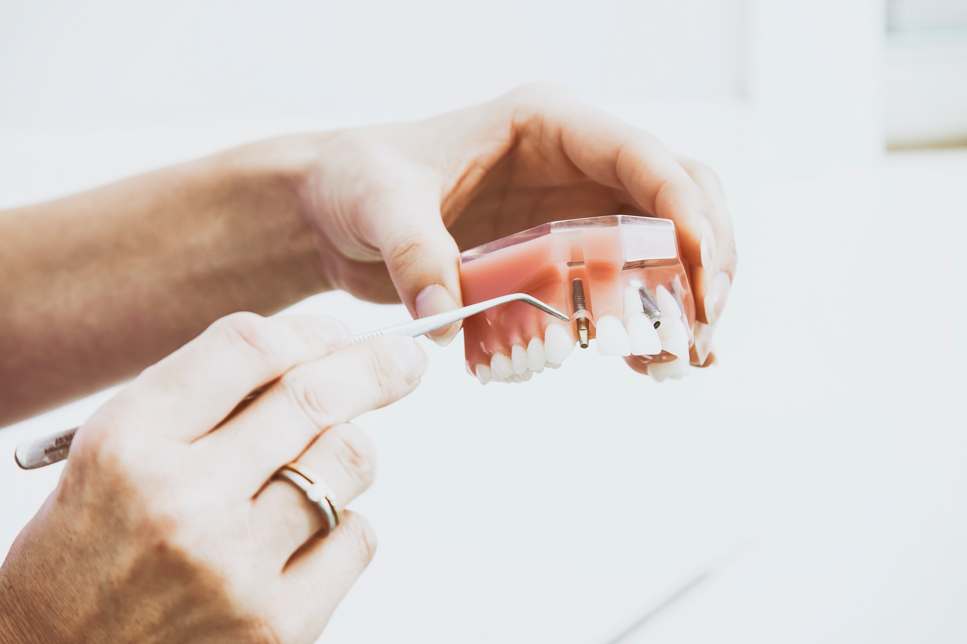 Mitos e verdades sobre implante dentário